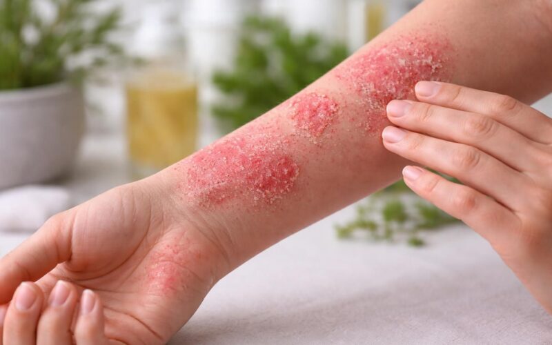 découvrez ce que signifie l'atopie pour la peau, ses causes, ses symptômes et comment prendre soin d'une peau atopique au quotidien.