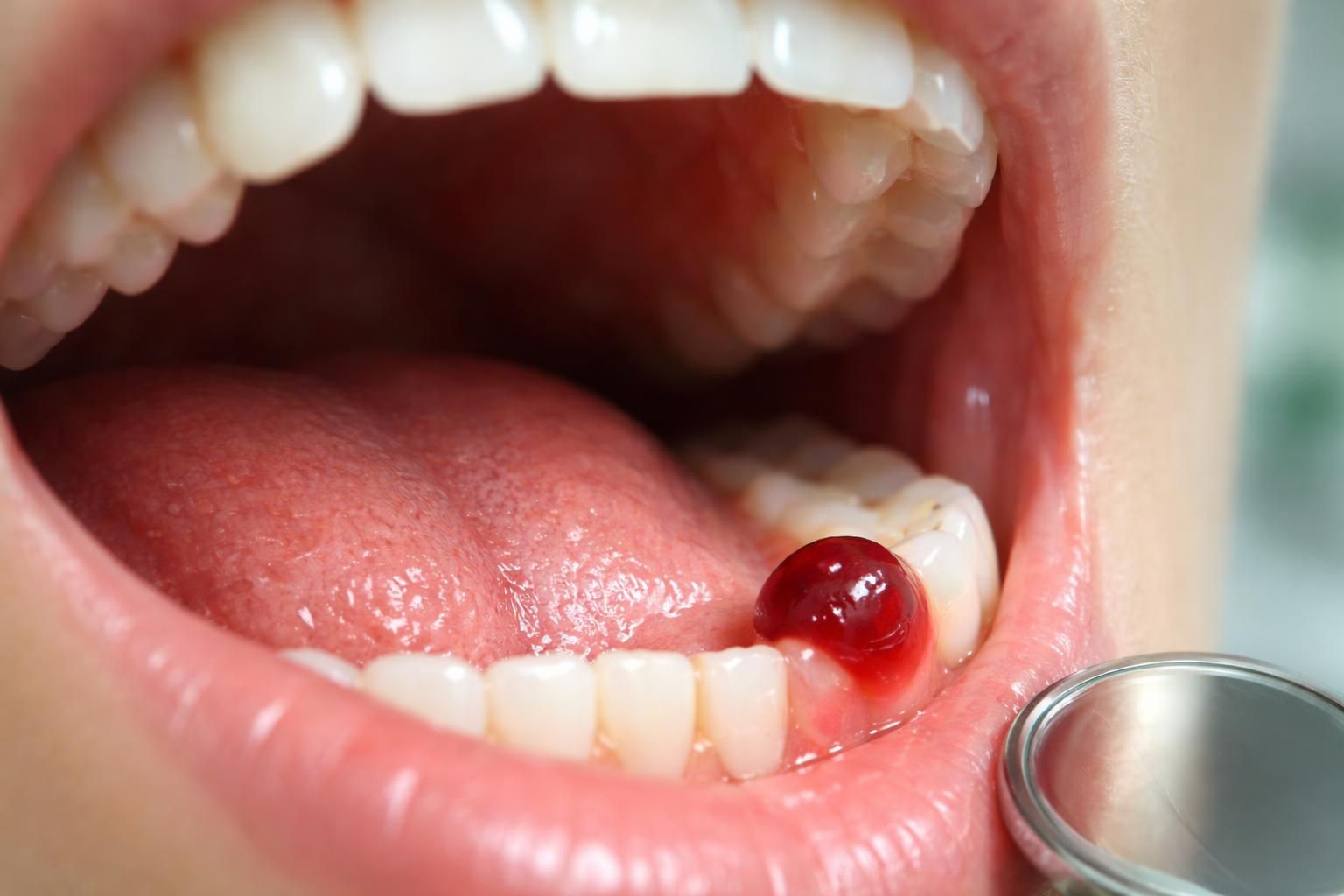 découvrez si la cloques de sang dans la bouche sont un mythe ou une réalité liée aux infections buccales, et apprenez à identifier les signes pour mieux protéger votre santé bucco-dentaire.