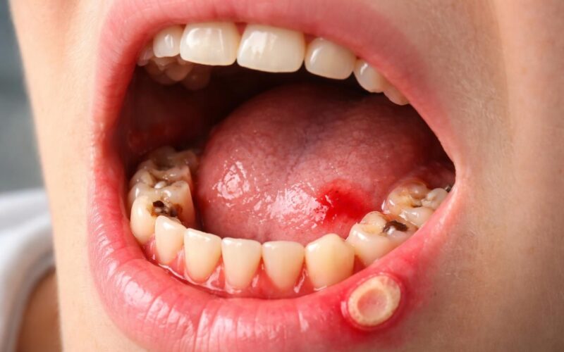découvrez les principales maladies buccales qui peuvent provoquer l'apparition de points de sang dans la bouche, leurs causes, symptômes et conseils pour les prévenir.