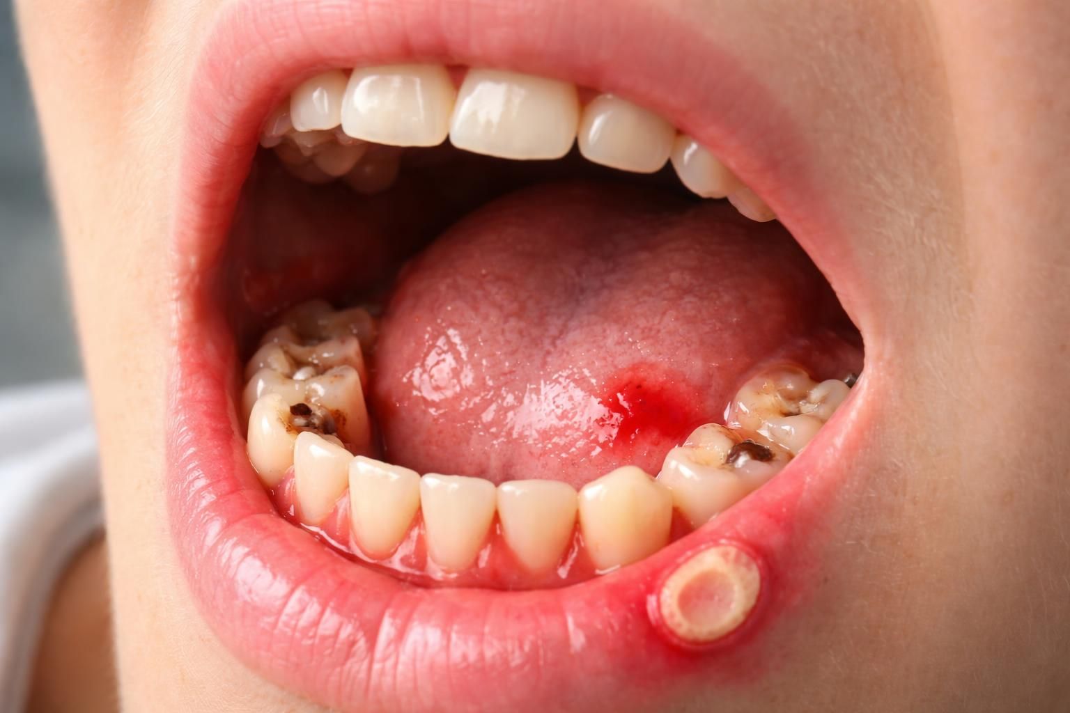 découvrez les principales maladies buccales qui peuvent provoquer l'apparition de points de sang dans la bouche, leurs causes, symptômes et conseils pour les prévenir.
